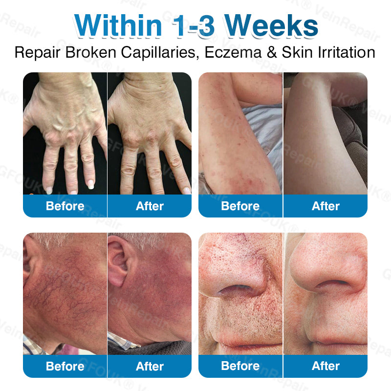 🏆🏃VeinRepair Microneedle Patch Roll⚡Instant Relief, Long-Term Results