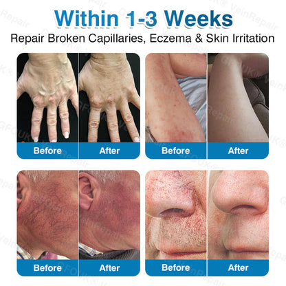 🏆🏃VeinRepair Microneedle Patch Roll⚡Instant Relief, Long-Term Results