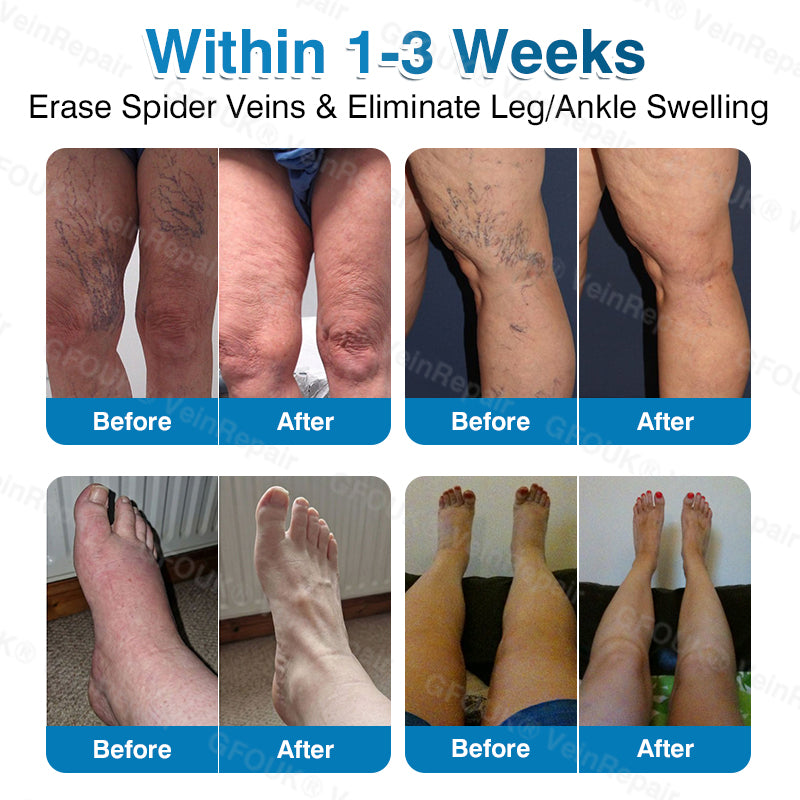 🏆🏃VeinRepair Microneedle Patch Roll⚡Instant Relief, Long-Term Results