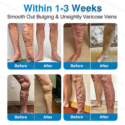 🏆🏃VeinRepair Microneedle Patch Roll⚡Instant Relief, Long-Term Results