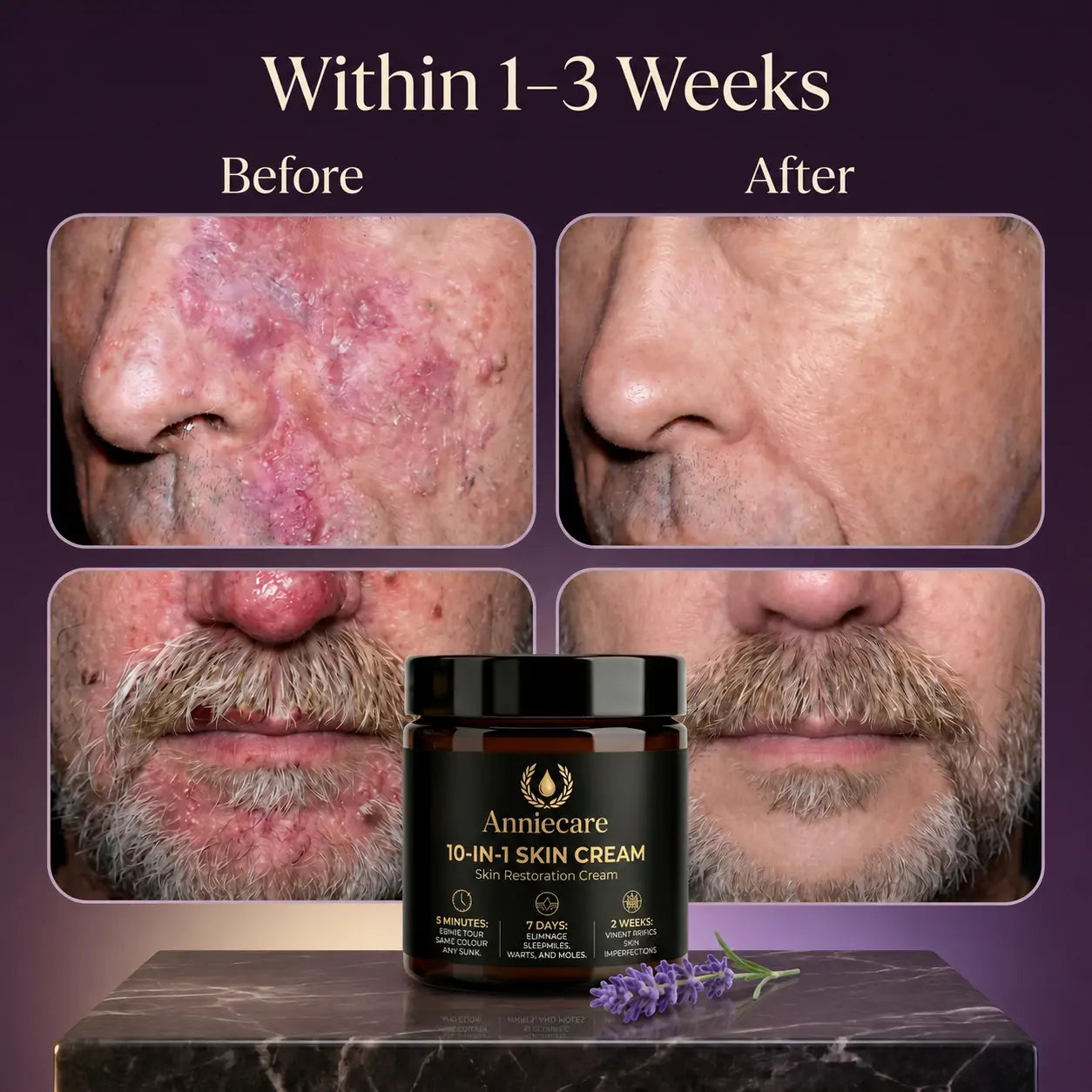 🔥LAST DAY 49% OFF🥇Anniecare™ 10-in-1 Skin Restoration Cream