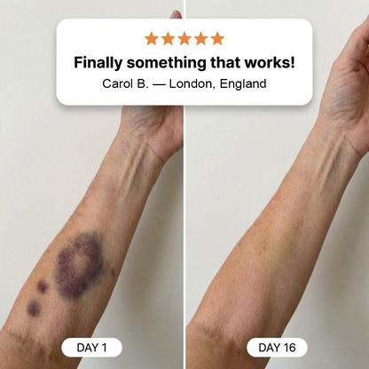 💥Over 100,000 units sold - Bruise Cream to repair bruises and strengthen the skin