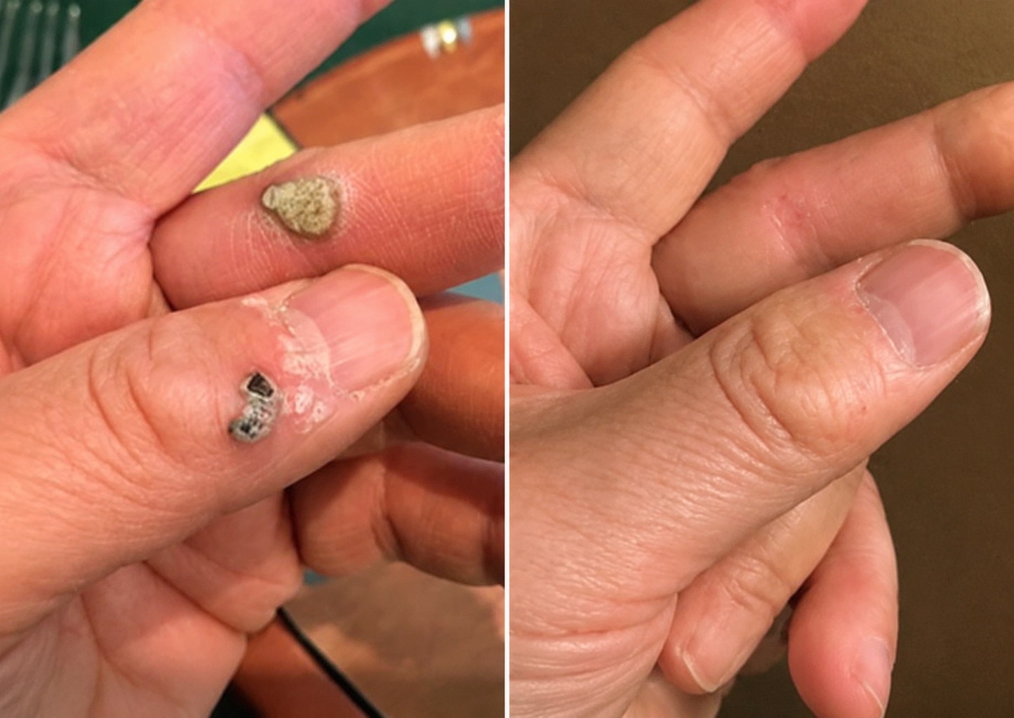Folivanago™ 2-in-1 Microneedle & Hydrocolloid Patch🍀| Removes Raised Moles, Acne, Flat Warts & Skin Tags | Helps Improve Wrinkles, Scars & Blemishes | Invisible Patches for Face & Body